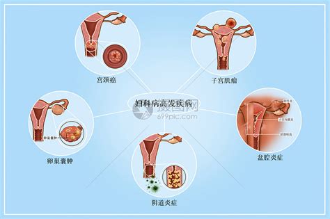 婦科病|婦科疾病列表